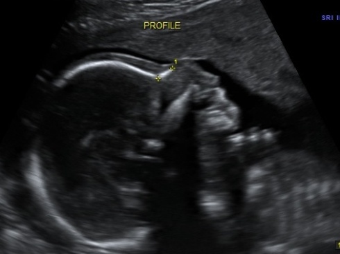 Profile of baby at 20 weeks